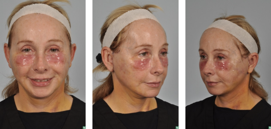 woman 5 days after face and neck lift 